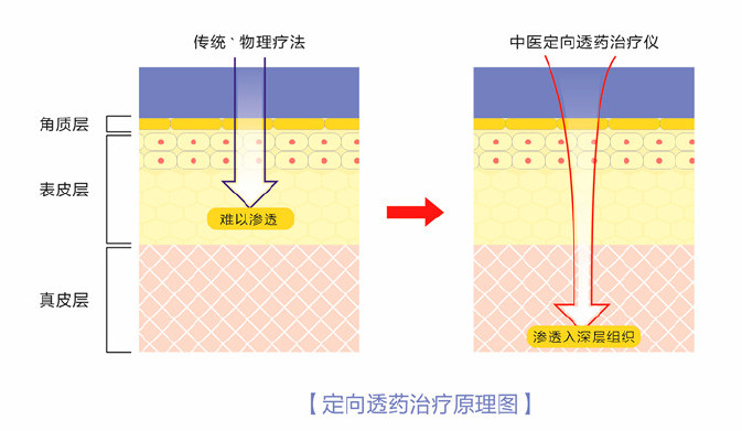 弘億康中醫(yī)定向透藥治療儀療法對比