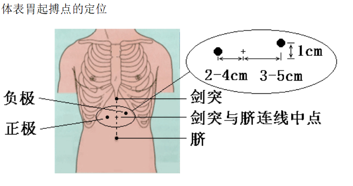 胃腸動力治療儀起搏點定位